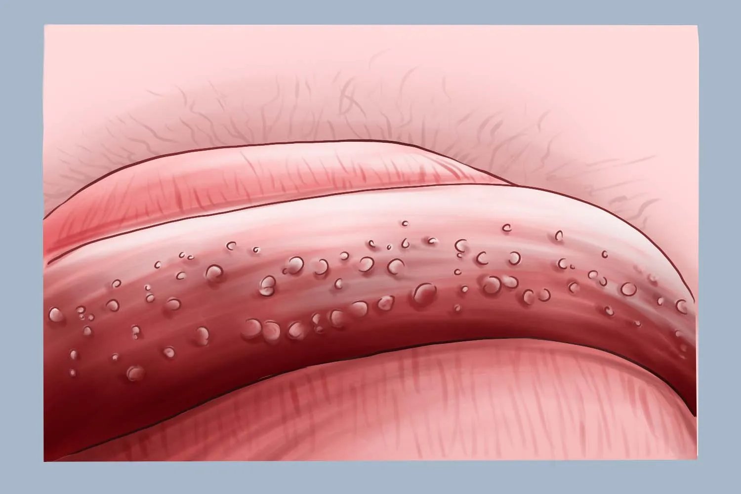 冠状珍珠丘疹图片大全