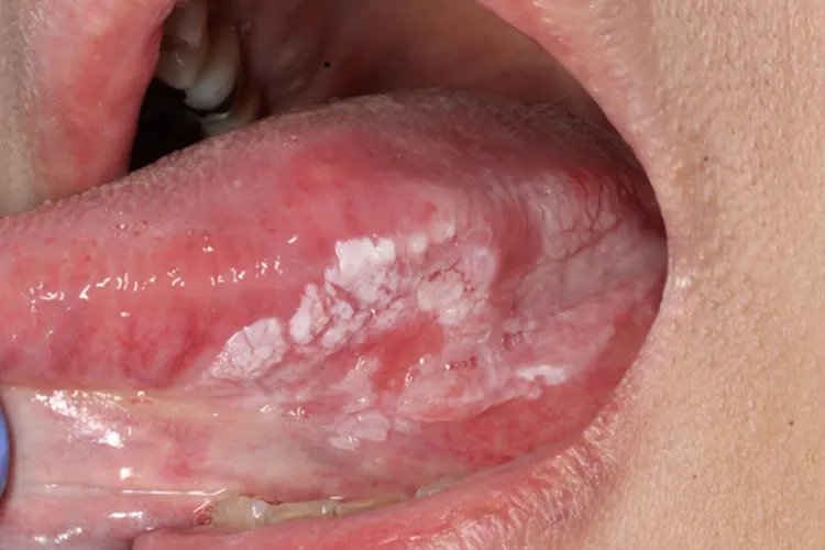 舌癌的早期症状图片