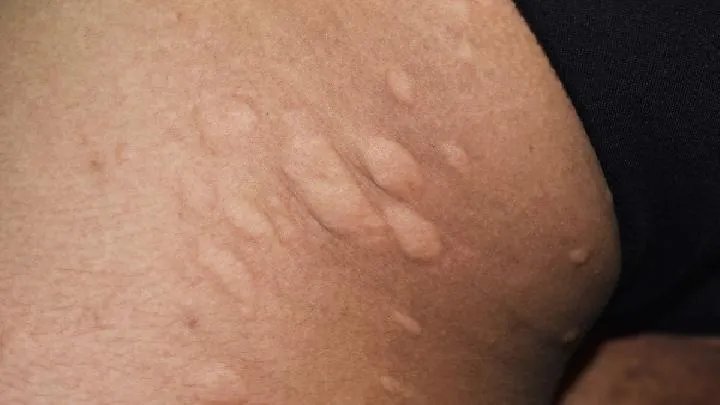 治疗黄褐斑偏方大全有哪些