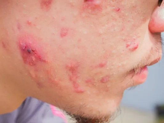 下颌痤疮的原因及预防