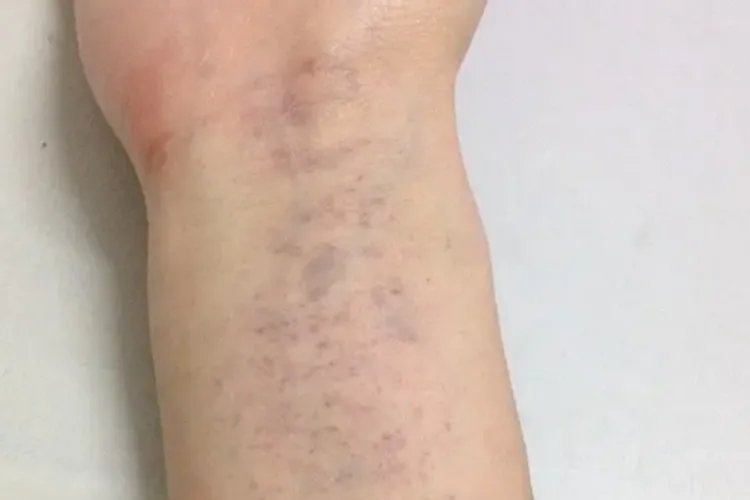 胳膊上长了很多红色的小点点图片