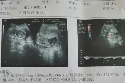 怀孕四个月B超单图片