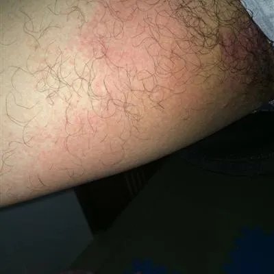 长多行红斑都会引起什么症状