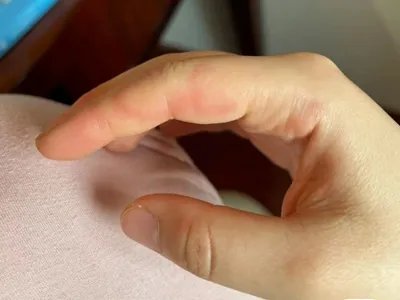 运动诱导性荨麻疹手指红斑图片