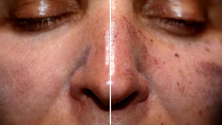 瑞尔黑变病病因是哪些