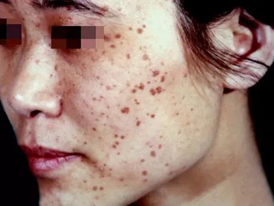 疣状表皮发育不良症状图片