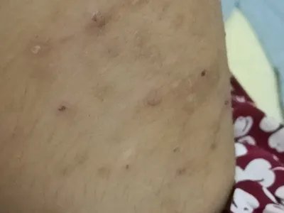 慢性湿疹腿症状图片