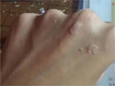 疣状表皮发育不良症状图片