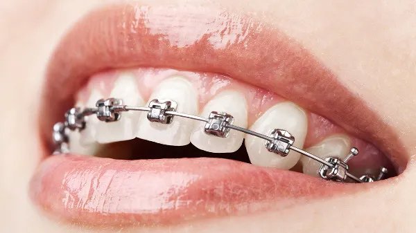 牙齿矫正的年龄