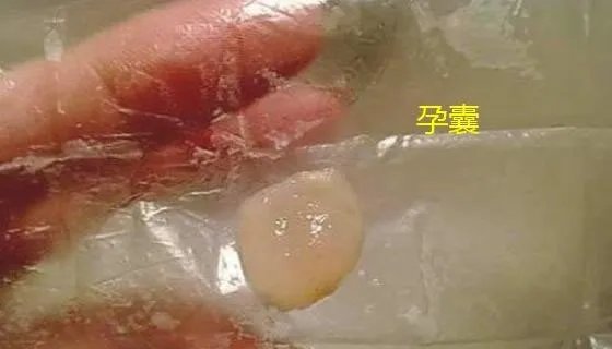 血块和孕囊的区别图