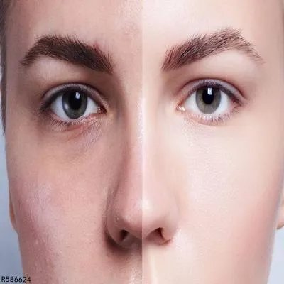 夏天晒黑了怎么快速美白