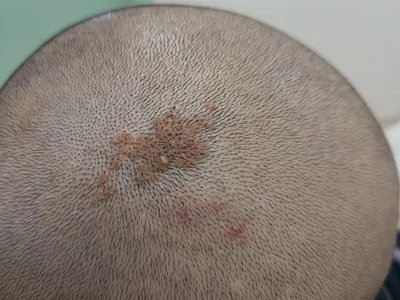 疣状表皮发育不良症状图片