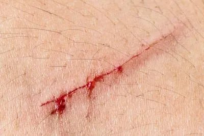 小伤口简单处理方法有哪些