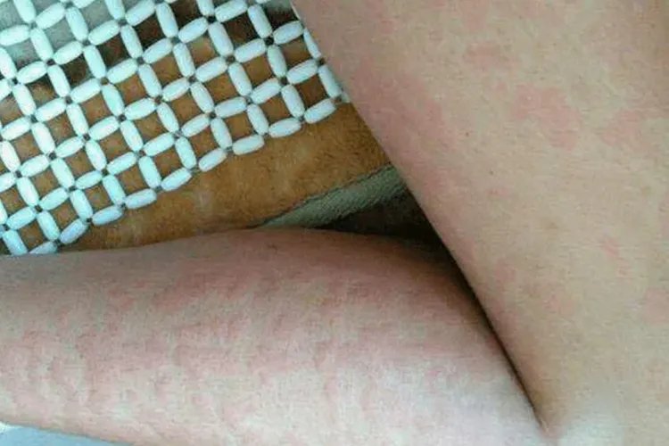 小腿皮肤过敏症状图片