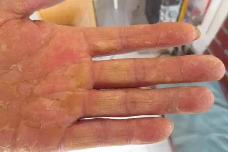 鹅掌风图片