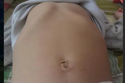 轻微鸡胸和正常人区别图片