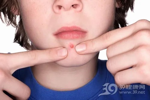 挤痘痘竟患败血症 挤痘痘有哪些危害？