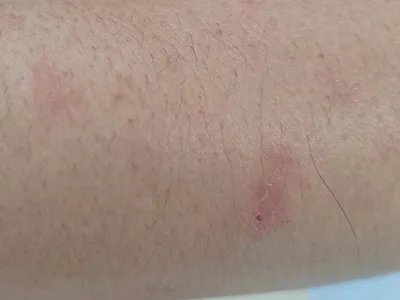 慢性湿疹腿症状图片