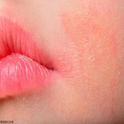 怎么消除掉面部红血丝