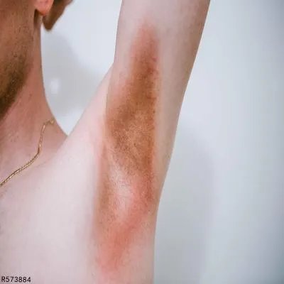 腋下长了个疙瘩要怎么处理