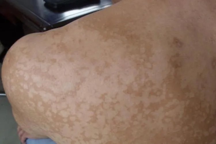 各种皮癣的图片大全