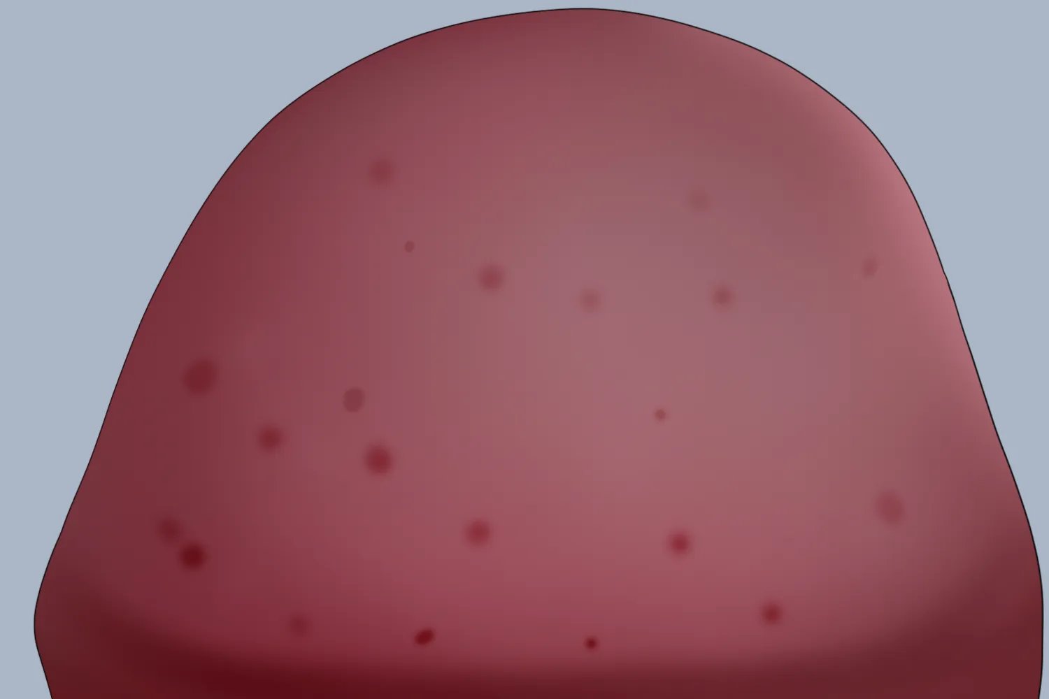 男性感染霉菌的症状是什么样子的