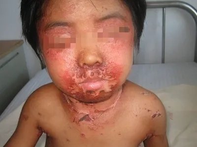 葡萄球菌性烫伤样皮肤综合征糜烂图片