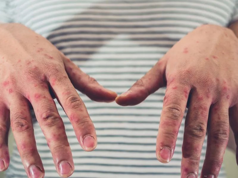 重症手足口病的注意事项