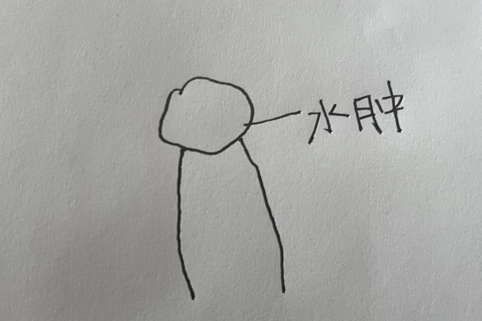 包皮环切手术术后水肿图片