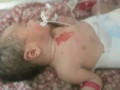 葡萄球菌性烫伤样皮肤综合征糜烂图片