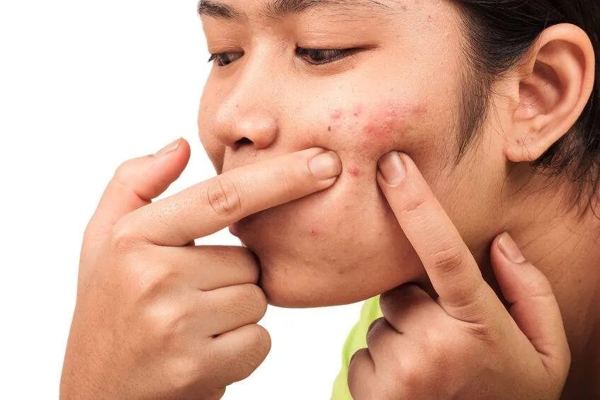 青春期怎样祛痘
