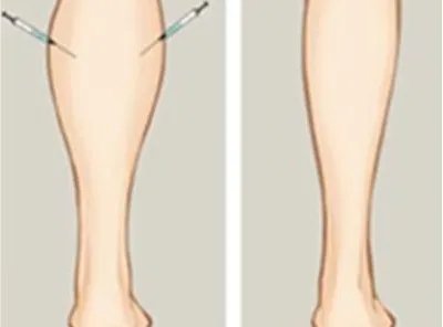 botox瘦腿针要多少钱