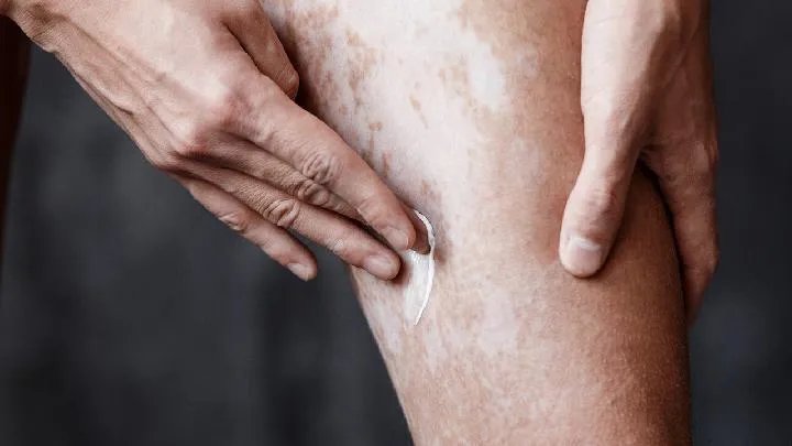 石家庄远大白癜风医院:白癜风禁忌有哪些