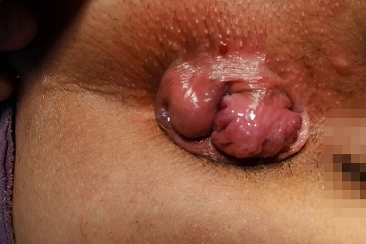 痔疮轻度与重度的图片