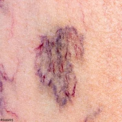 过敏性紫癜的食疗方法有哪些