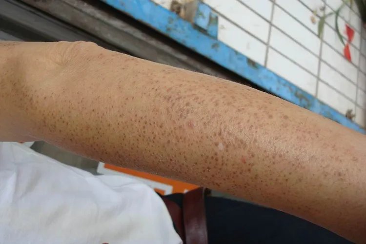 毛孔角化症图片