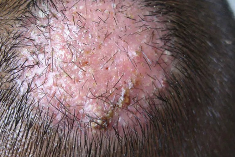 各种皮癣的图片大全