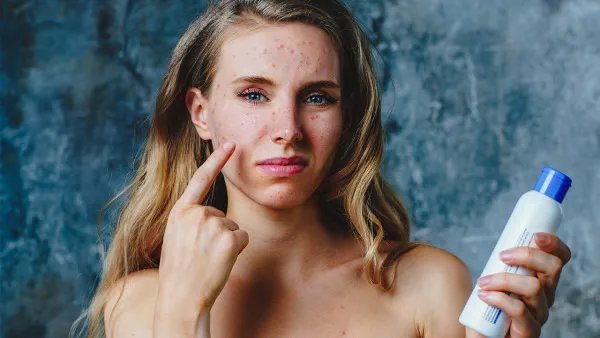 痤疮感染了怎么办