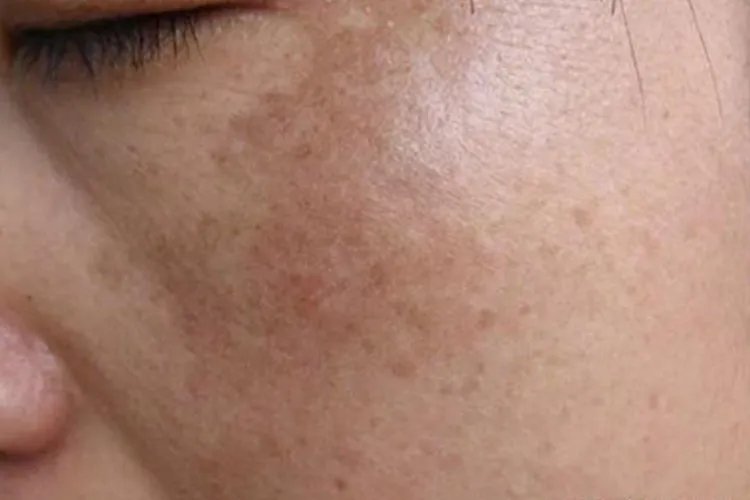 激素斑的症状图片