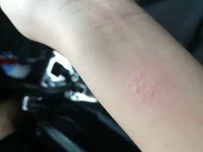 急性单纯性痒疹胳膊水疱图片