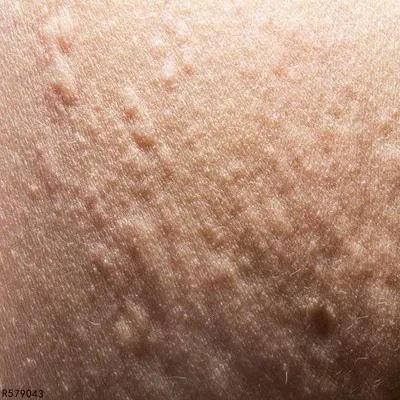 寒冷荨麻疹该怎么治疗 寒冷荨麻疹可用这几个方法控制