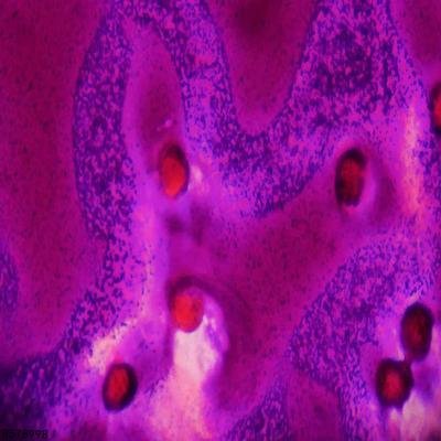 血小板减少的后果有哪些