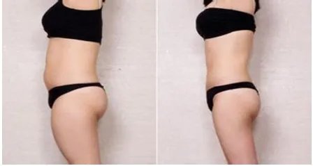 上背部吸脂费用是多少