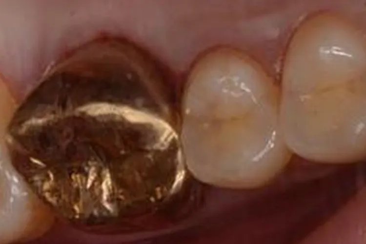 单颗牙套有几种图片