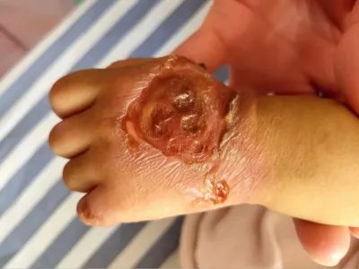 葡萄球菌性烫伤样皮肤综合征糜烂图片