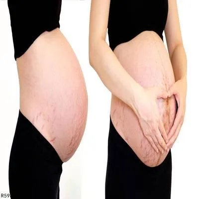 妊娠纹消除的方法有哪些 妊娠纹的3个消除方法很有效