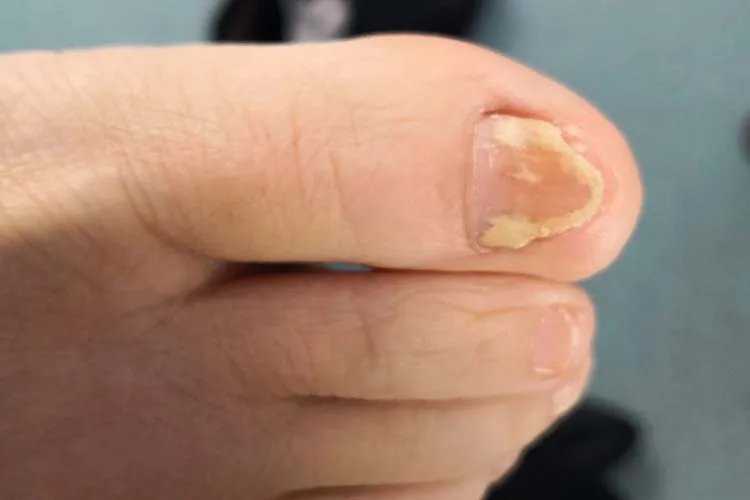 怎么确定是不是灰指甲图片