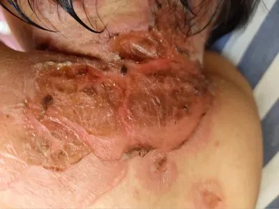 葡萄球菌性烫伤样皮肤综合征糜烂图片