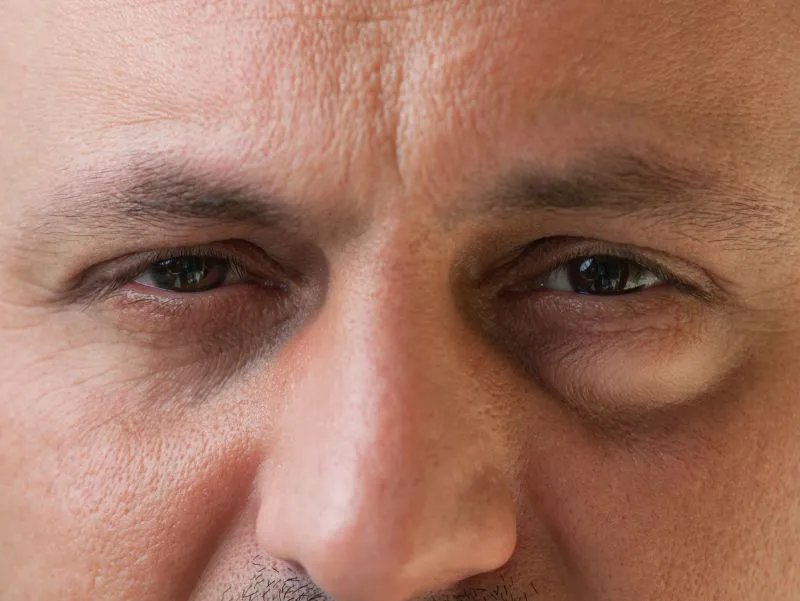 眼圈发红是什么原因