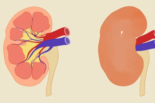 嘌呤代谢紊乱是怎么回事